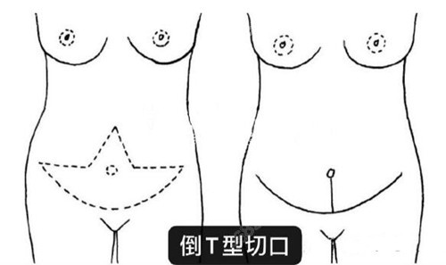 腹壁成型倒T切開(kāi)法
