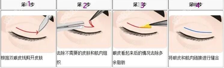 白华宝割双眼皮口碑怎么样