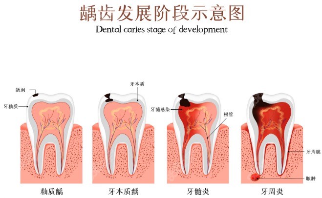 龋齿发展示意图