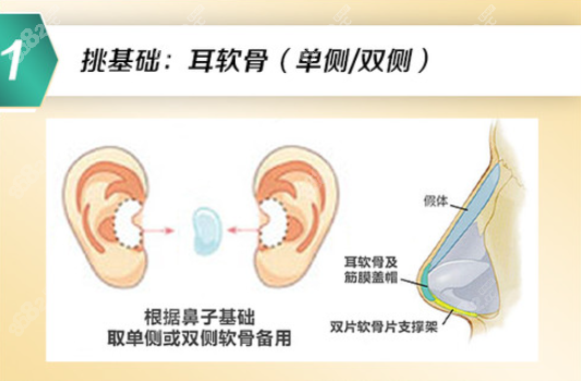 耳软骨鼻综合包括哪些项目