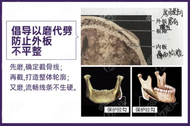 重庆华美磨截联合长曲线下颌角术优势