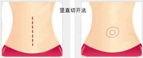 腹壁成型豎直切開(kāi)法