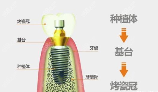 种植牙的构造结构图