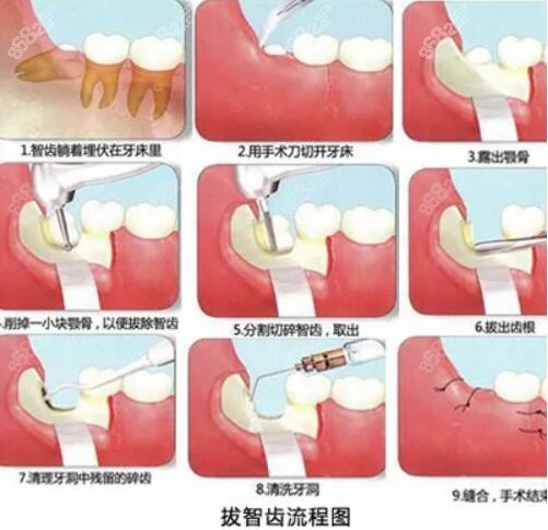 拔智齿流程图