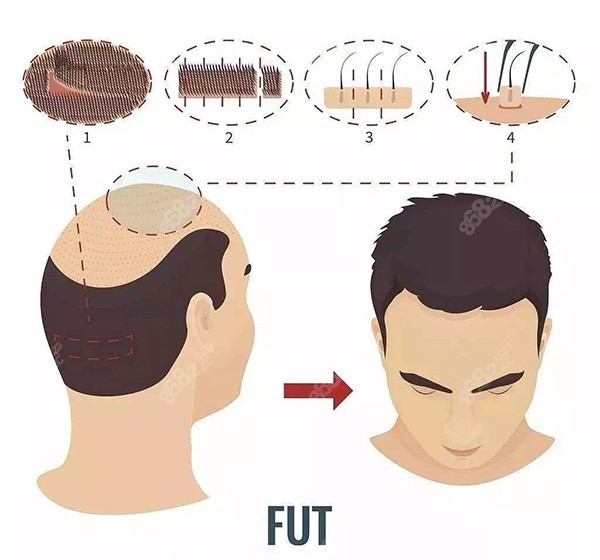 有痕植发FUT技术