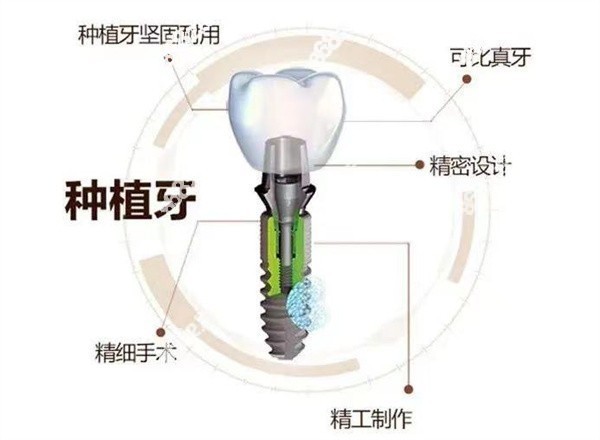 牙齿缺失选择种植牙的优势