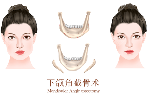 下颌角截骨术