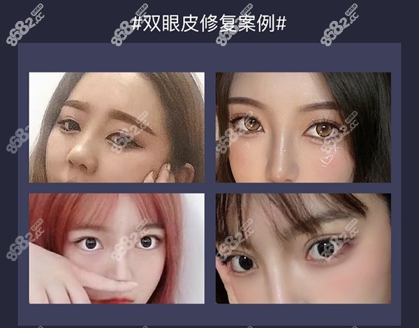 虞晓徐双眼皮修复病例