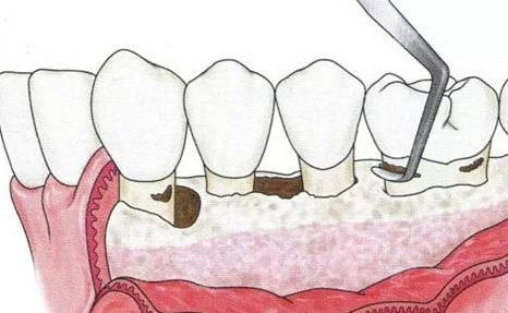 牙周病引起的牙槽骨吸收不可恢复