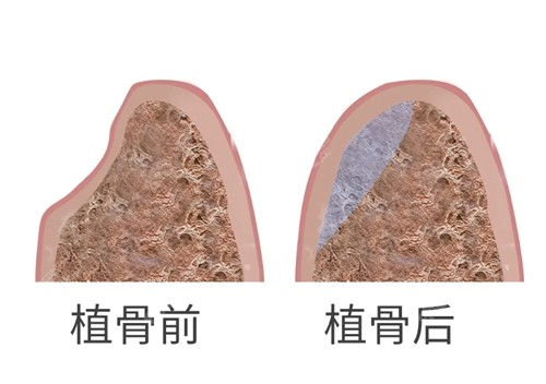 植骨会不会很疼