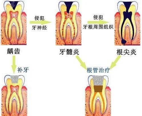 根尖炎引起的牙槽骨吸收可以恢复