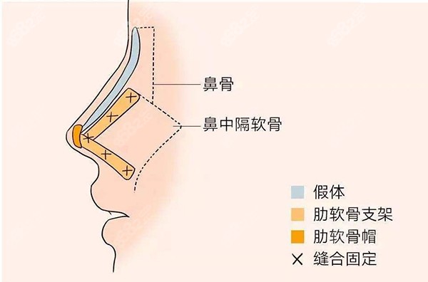 肋骨隆鼻