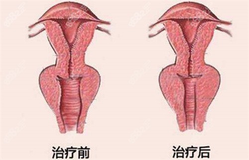 缩阴手术改善前后模拟图