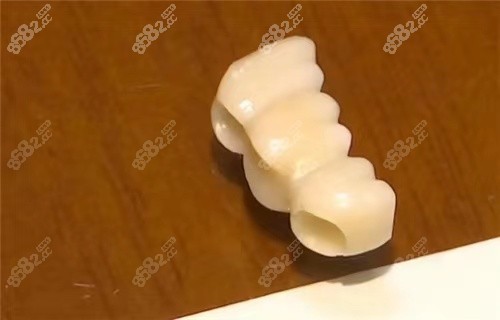 种植牙的牙冠哪种好