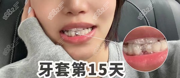 30多岁不建议做正畸
