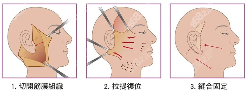 拉皮手术步骤%8682网