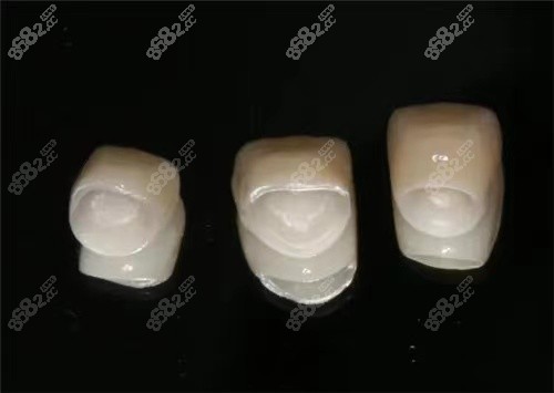 种植牙的牙冠用全瓷还是烤瓷