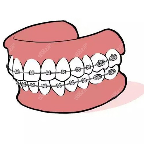 晋中做传统金属托槽固定矫正牙齿
