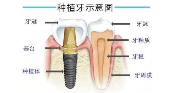 种植牙为什么咬合力那么大