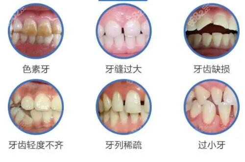 美加牙齿贴面适用情况