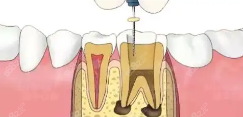 儿童做根管治疗有没有后遗症或危害呢