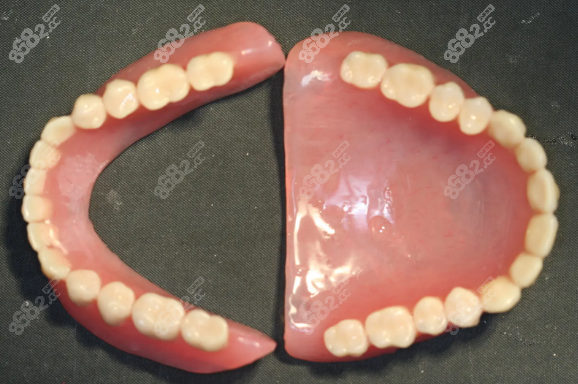 老人适合安装的假牙二:活动义齿