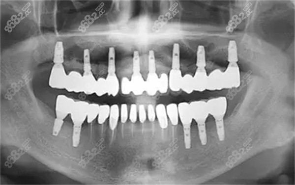 全口种植牙