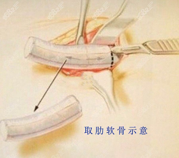 肋骨隆鼻肋骨取了对身体有影响吗