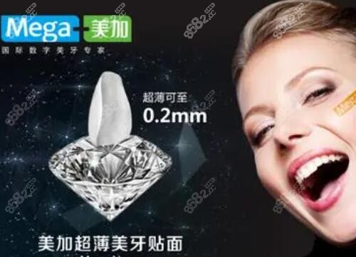 美加牙齿贴面