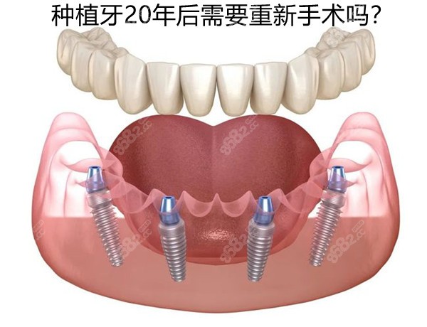 种植牙20年后还要重新手术吗?揭晓种植牙几十年后怎么处理