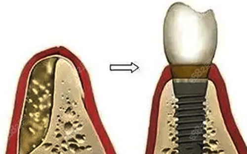 植入骨粉后进行牙齿种植