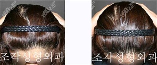 骨水泥填充前后對比照片 骨水泥填充前后對比照片