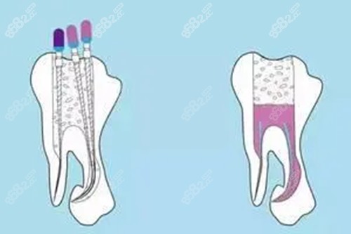 根管治疗