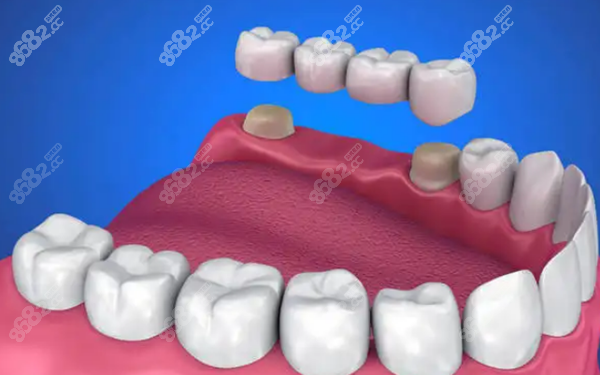 牙列缺失做固定假牙价格