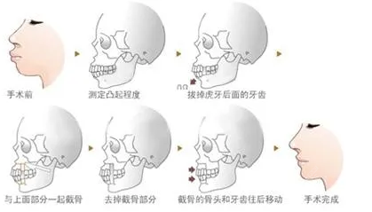 40岁能做正颌手术