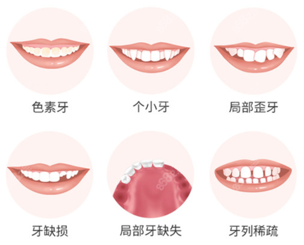 牙贴面适合症状有哪些