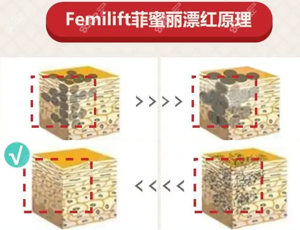 飞顿菲蜜丽私密漂红原理示意图