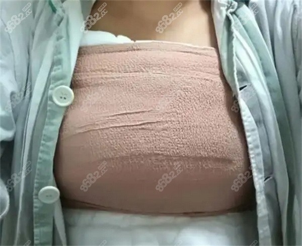 产后胸下垂 17岁图片