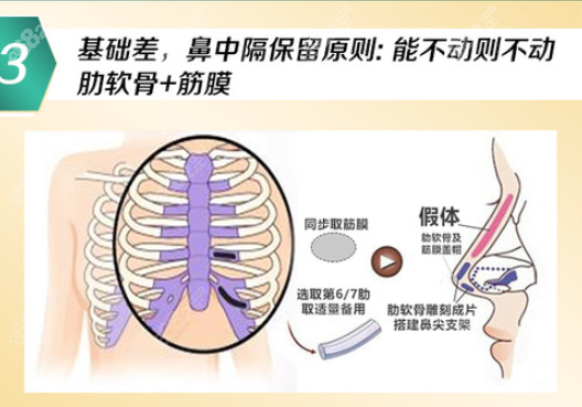 隆鼻有必要包筋膜吗