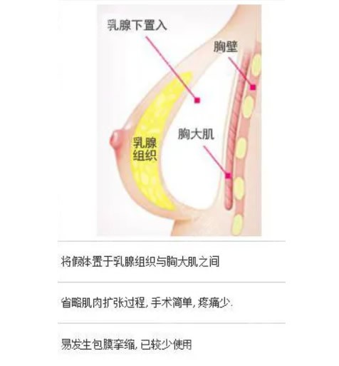 乳腺假体隆胸优缺点有哪些