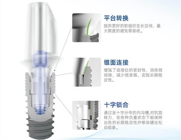 康盛种植体的亮点介绍