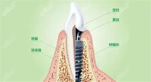 下门牙缺了能做种植牙的哦