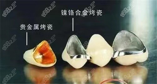 种植牙根据具体情况来选择植体