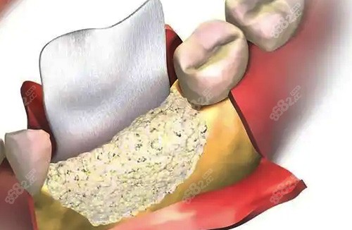 哪种情况下需要植入骨粉