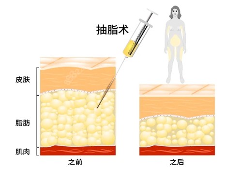 全身吸脂可以一次性完成吗