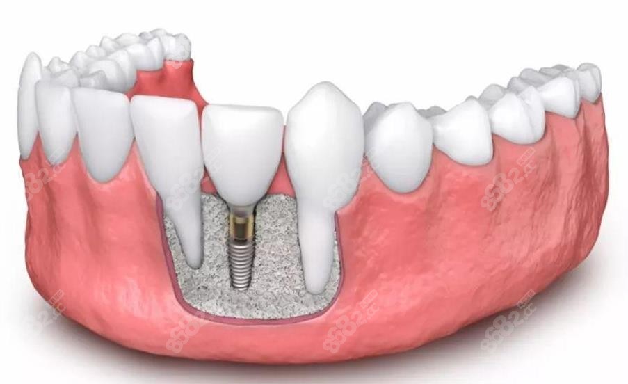 <!--<i data=20240705-sp></i>-->种植牙人工骨粉费用是多少钱