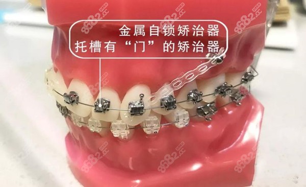 金属自锁托槽牙套展示