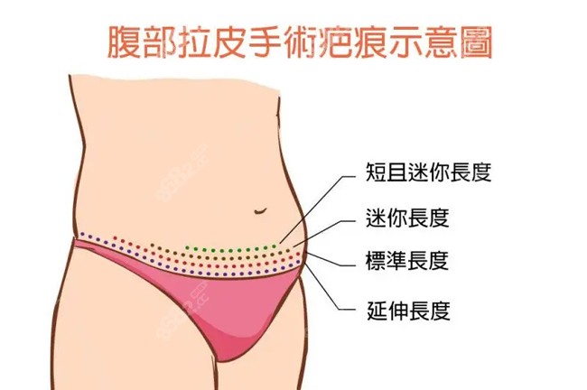 腹部拉皮手术中不同切口的疤痕图