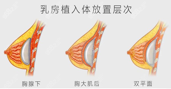 隆胸双平面和胸大肌哪个植入点更好一点