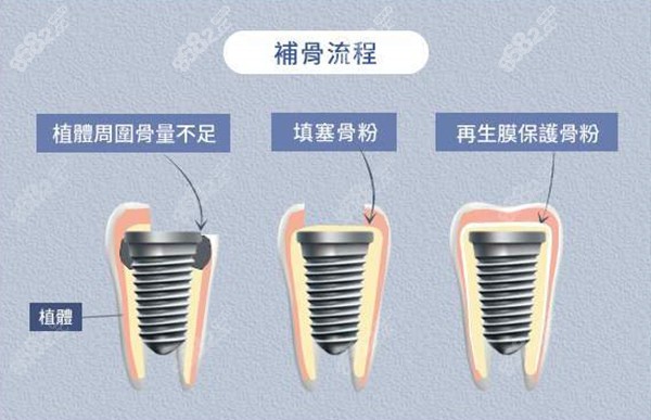 思明种植牙骨粉国产和进口的区别